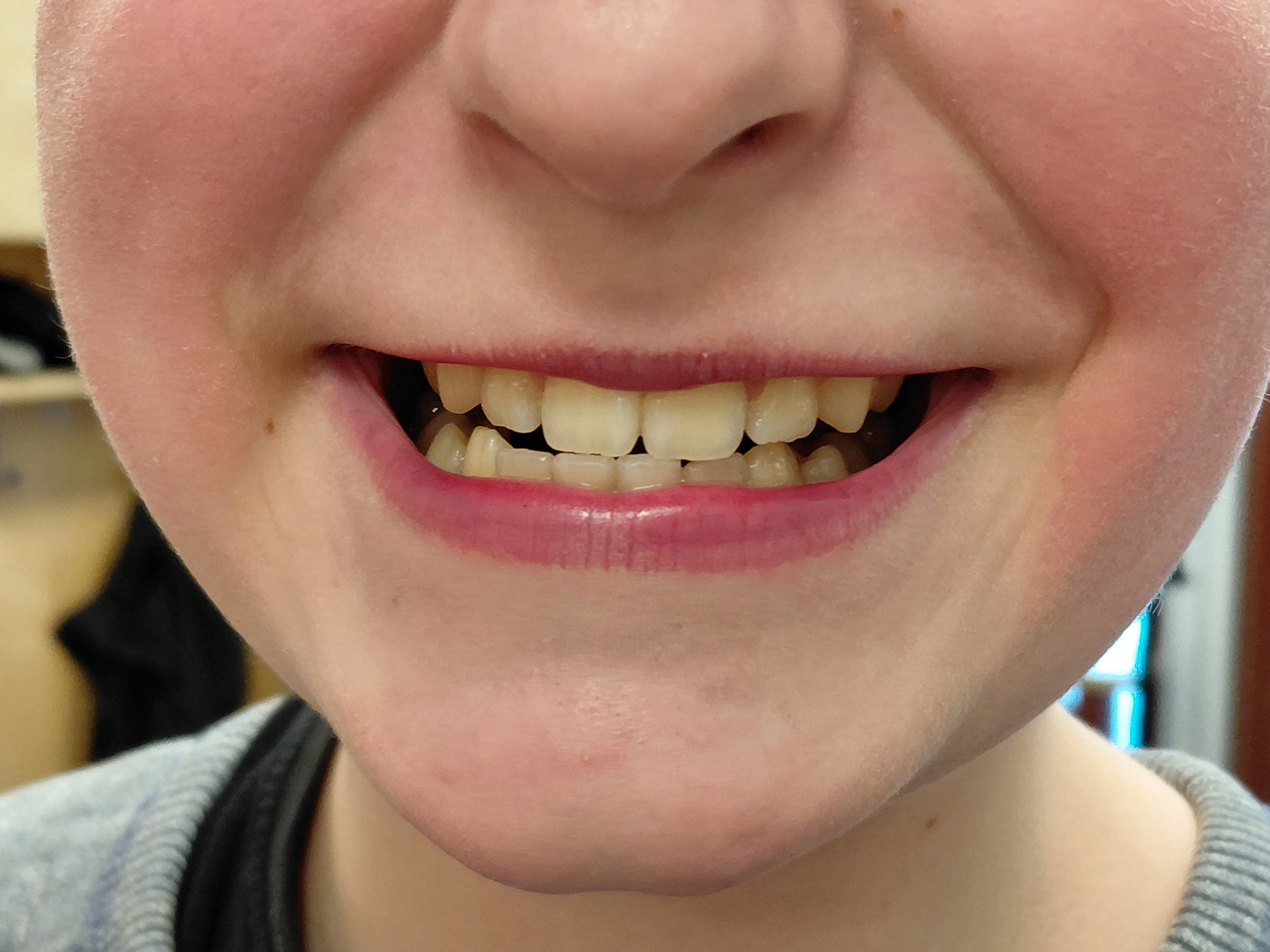 

Elias Kokkonen tunnusti, että aamulla oli kiire ja hampaiden harjaamiseen meni vain viisitoista sekuntia. Muistisääntö on, että hampaita pitää harjata aamuin illoin kaksi minuuttia. 